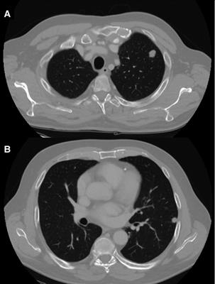 Preoperative CT-Guided Near-Infrared Dye Marking for Thoracoscopic Resection of Pulmonary Nodules: A Case Report